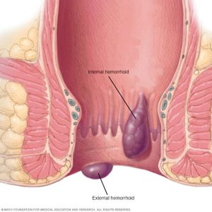 hemorrhoidsthu